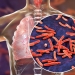 Ilustrasi penyakit Tuberculosis (TBC). (Dok. Shutterstock)